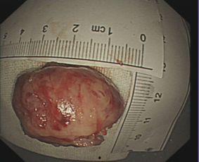 胃间质瘤在线视频,病因、症状及治疗策略